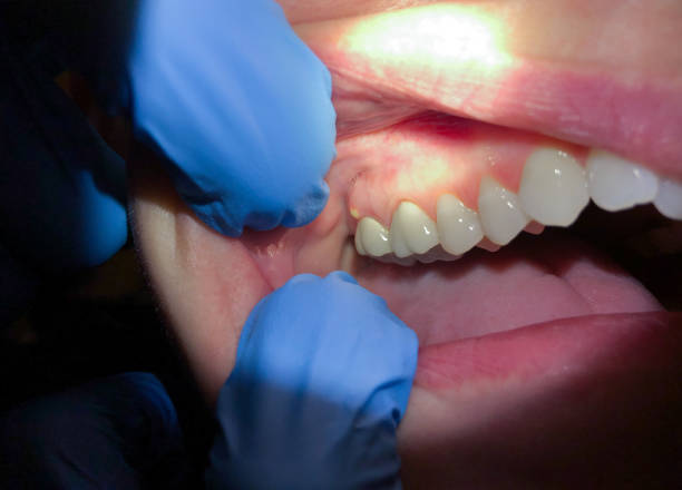 Best Emergency Wisdom Tooth Extraction in Oxford, KS