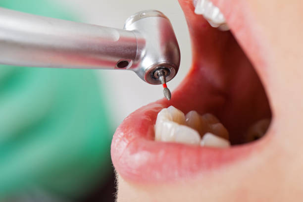 Best Broken or Chipped Tooth Repair in Oxford, KS